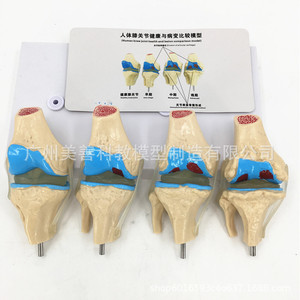 Modelo esquelético patológico de articulación de rodilla en cuatro partes; modelo de articulación de rodilla patológica/con lesiones; articulación degenerativa. - Product Image 2