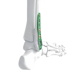 Placa de Implante para Trauma con Bloqueo <span class=keywords><strong>Proximal</strong></span>, Distal, Lateral, Humeral, Radiáculo, Única, Femoral y Tibial - Product Image 6