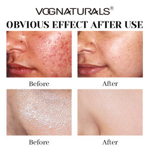 Borrador de enrojecimiento Caléndula Lavado facial Loción vegana suave <span class=keywords><strong>Gel</strong></span> Aceite Hidratante Vitamina C Té verde Faciales calmantes - Product Image 4