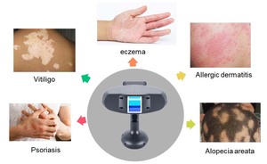 Schiereiland 311nm 308nm <span class=keywords><strong>Uvb</strong></span> Uva Lamp Fototherapie Voor Vitiligo - Product Image 5