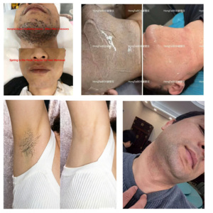 Appareil d'épilation au <span class=keywords><strong>laser</strong></span> à diode HONGTAI-CEL pour femmes, 755 nm, refroidissement par glace, épilation du visage, des aisselles, de la ligne du bikini - Product Image 6