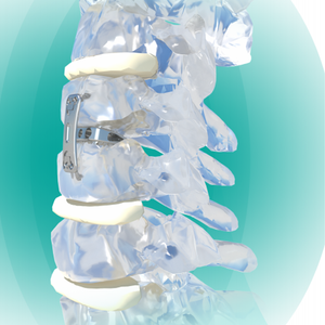 Cale en alliage de titane médical chirurgical incurvé fusion interbody cervicale antérieure <span class=keywords><strong>implant</strong></span> de chirurgie orthopédique classe certifiée CE - Product Image 2