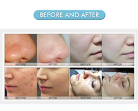 Meilleur prix – Machine à oxygène Hydro Jet Peel Hydradermabrasion pour le nettoyage du visage, élimination de l'acné et des points noirs, nettoyage des pores – Prise US/UK
