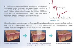 Máquina láser portátil de eliminación de vasos sanguíneos <span class=keywords><strong>vasculares</strong></span> de araña de 980nm, equipo de piel, máquina de belleza láser - Product Image 4