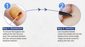 Prix Agent : Demander Plus d'Informations sur le Nouvel Appareil d'<span class=keywords><strong>Électrolyse</strong></span> et d'Aiguille de Beauté pour le Soin du <span class=keywords><strong>Visage</strong></span>, du Corps et des Cheveux, Machine d'<span class=keywords><strong>Électrolyse</strong></span> Avancée à Vendre - Product Image 5