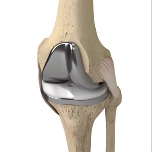 Sistema de Implante de Rodilla Cruciate Retaining para Uso Médico, Prótesis Articular, Prótesis de Rodilla CR - Product Image 1