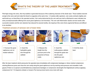 Mesin Perawatan Laser Dioda 980nm 1470nm untuk Penghapusan Varises Medis, Varises Endovenous, Varises Kapiler, dan Varises Laba-laba - Product Image 5
