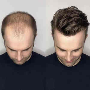 Ampia Disponibilità di Toupet da <span class=keywords><strong>Uomo</strong></span> con Base Australiana, Capelli Umani Europei 100% Vergini, Cuticole Allineate, Nodi Decolorati, Colore Marrone - Product Image 5