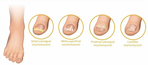 Appareil professionnel de traitement des mycoses des ongles pour l'onychomycose et l'élimination des champignons des ongles - Product Image 3
