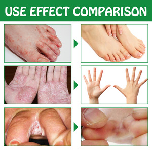 Spray para Hongos, Dermatitis y Callosidades South Moon: Cuidado Hidratante para Manos y <span class=keywords><strong>Pies</strong></span>, Alivia Bolitas, Olor y Picazón - Product Image 4