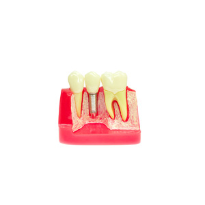 Modèle dentaire, modèle pédagogique buccal, modèle d'implant dentaire détachable, modèle de communication médecin-patient, modèle de soins dentaires - Product Image 3