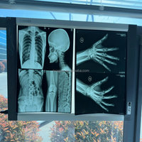 Film sec universel pour radiologie médicale / Film thermique bleu médical 14*17 pouces / Film pour imprimante à rayons X pour hôpital