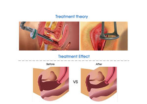 Co2 레이저 질 회춘 흉터 제거 프락셔널 피부 미용 장비 프락셔널 Co2 레이저 기계 - Product Image 4