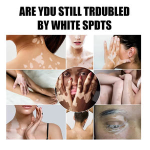 OEM Crème de soin pour le corps en plâtre chinois au venin d'abeille et au <span class=keywords><strong>vitiligo</strong></span> pour les mains et les pieds, complément pour les soins de la peau - Product Image 4