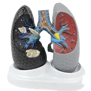 Mô hình y tế của các cơ quan nội tạng của con người Mô hình giải phẫu của phổi hút thuốc nguy hiểm