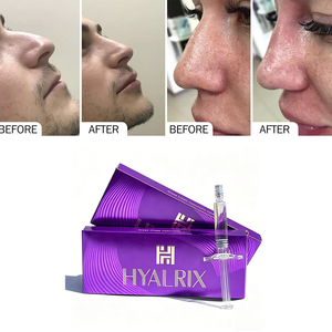 Hyalrix Deep 1.1ml Cross Linked <strong>Hyaluronic</strong> <strong>Acid</strong> Dermal Filler for Cheek <strong>Jawline</strong> Deep Volume Restoration Facial Contour <strong>Injection</strong> - Product Image 3
