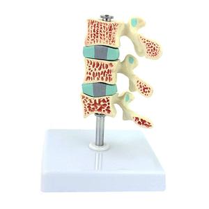 Gelsonlab HSBM-139 Tulang Belakang Model Anatomi, Model Osteoporosis, Ntervertebral Disc Model Perut Ortopedi Nyeri Model - Product Image 1
