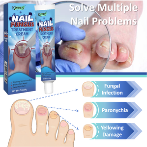 Gel Perbaikan Kuku Kaki Anti Jamur, Serum Perawatan Jamur Kuku, Krim Anti Infeksi, Salep Herbal Cina - Product Image 6