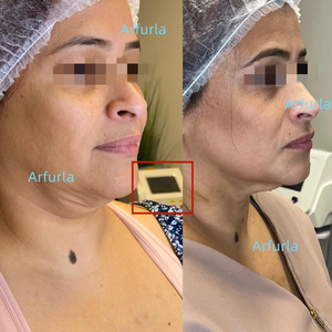 Fibra Endolaser para lipólise Cut Soft Tecido Bodylift Fibra Óptica SMA905 - Product Image 6