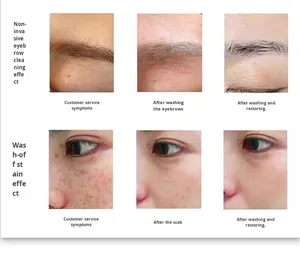 Nouveau PICO de 2e génération pour le bureau, élimination non invasive des tatouages de sourcils, sans eau, élimination des taches Ultra-Pico, blanchiment, beauté, prise US - Product Image 5
