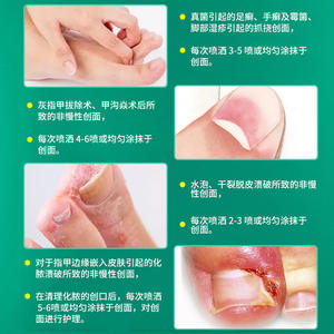 Spray herbario OEM para heridas en los pies, anti-picazón, para enrojecimiento y hongos en los pies. - Product Image 5