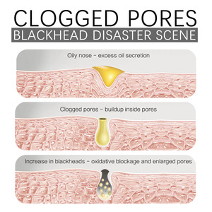 <b>Blackhead</b> <b>Removal</b> Mask Cleanses <b>Blackheads</b> Lightens Pimples Tightens Pores and Controls Oil Smearing for Face - Product Image 4