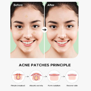 얼굴 살리실산 및 티 트리 여드름 스티커 치유 여드름을위한 투명 상처 드레싱을위한 하이드로 콜로이드 여드름 패치 - Product Image 3