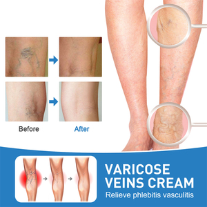 EELHOE Crema para Várices, Crema para el Tratamiento de Várices Reticulares y Úlceras Troféricas, Set de Lápiz Láser para Arañas Vasculares - Product Image 4