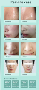 เครื่องฟื้นฟูผิวหน้า 10in1 Hydra Oxygen พร้อมไมโครเดอร์มาเบรชั่น H2O2 Aqua Clean สำหรับความงามและการดูแลส่วนบุคคล - Product Image 6