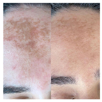 Éponge exfoliante naturelle aux algues et herbes pour la resurfaçage de la peau, élimination des taches d'acné, de pigmentation, des taches brunes et des vergetures