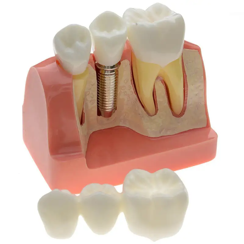 نموذج زرع الأسنان/تحليل زرع الأسنان ، محمول ، قابل للإزالة ، راتينج ، سن إنسان ، نموذج