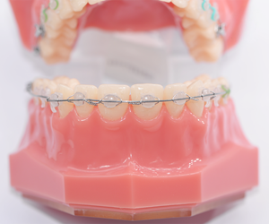 2S ortodontico dentale MBT ceramica staffe auto-leganti con strumento dalla cina - Product Image 5