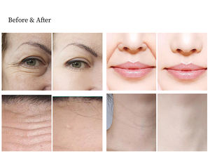 Appareil de beauté professionnel HIFU 7D à 1 ligne 2026 en ABS, à haute intensité focalisée pour le visage - Product Image 4