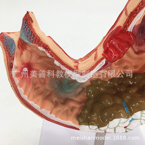 Modèle de simulation pédagogique d'estomac pathologique, modèle d'anatomie d'estomac pathologique, spécimens d'anatomie viscérale et un autre modèle. - Product Image 2