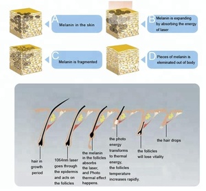 Épilation au laser à impulsions longues ADSS ND:YAG 1064 nm pour toutes les couleurs de peau Modèle : LP2016 - Product Image 5