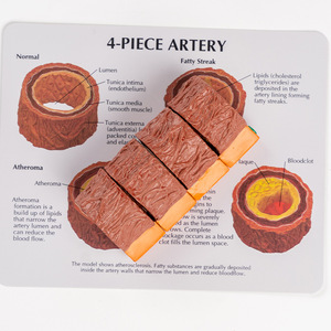 Modelo de formación de aterosclerosis y trombosis de arteria, modelo de Anatomía Humana, modelo de proceso de esclerosis vascular de cuatro etapas - Product Image 2