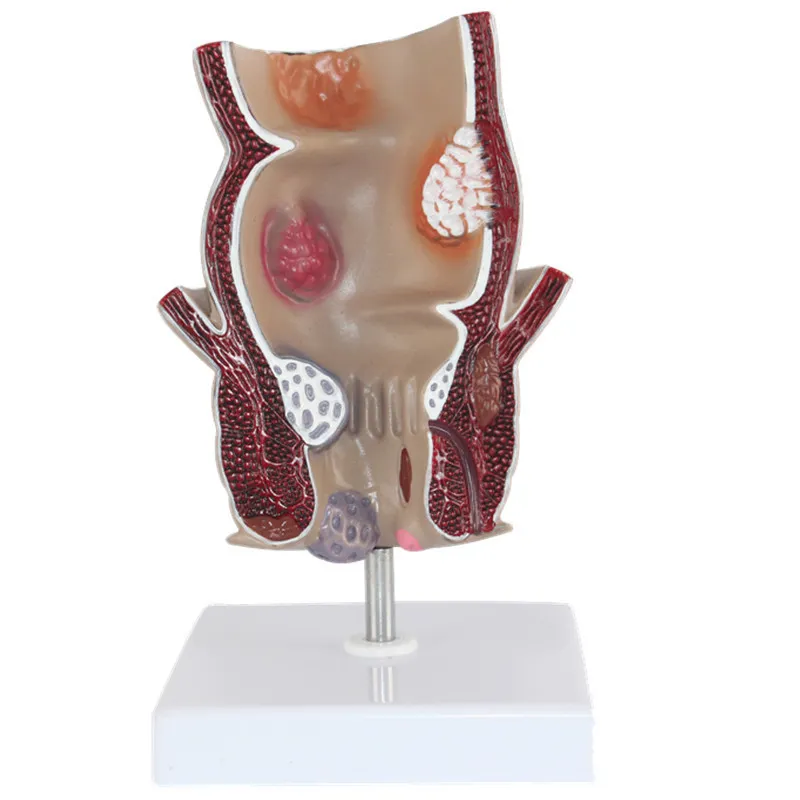 Sciedu Bowel Anatomy Models Intestines Medical Anatomical Model Rectal Disease Demonstration Model