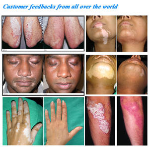 Lampu Fototerapi <span class=keywords><strong>UVB</strong></span> <span class=keywords><strong>Narrowband</strong></span> Portabel Kernel UVDERMA untuk <span class=keywords><strong>Psoriasis</strong></span>, Vitiligo, Eksim Kn4003 - Product Image 3