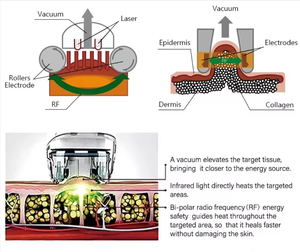 Masseur portable Vela Body Shape V9 pour le remodelage corporel, anti-cellulite, rouleau dermique, rouleau à billes interne, sculpture corporelle, drainage lymphatique - Product Image 4