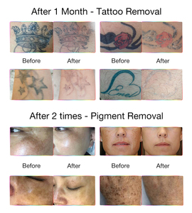 Picoseconde Laser <span class=keywords><strong>Q</strong></span> Switch Traitement de l'acné Détatouage Laser Équipement de beauté - Product Image 6
