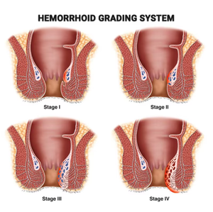 Salep Herbal Alami untuk Wasir, Mengatasi Nyeri, Bengkak, Pendarahan, Gatal, Fisura, Wasir Internal dan Eksternal - Product Image 2