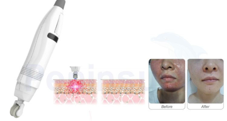Peninsula Fractional RF Micro Needle Skin Care System 240V 9