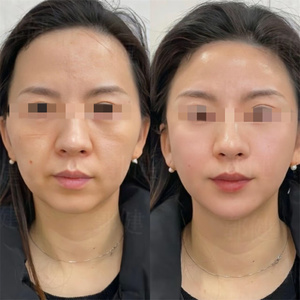 G tần số vô tuyến Microcurrent ngón tay Vàng mặt nâng cơ thể Massager <span class=keywords><strong>RF</strong></span> vẻ đẹp máy hấp dẫn kim cương ngón tay - Product Image 6