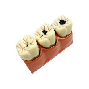 Modèles de comparaison des caries (4 fois grandis), Modèle de dents décomposées pour l'enseignement, la <span class=keywords><strong>recherche</strong></span> et l'étude en dentisterie pour étudiants - Product Image 1