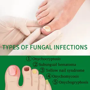 Protetor anti-soro antifúngico para pés, tratamento antifúngico para unhas, soro reparador removedor de onicomicose em 7 dias