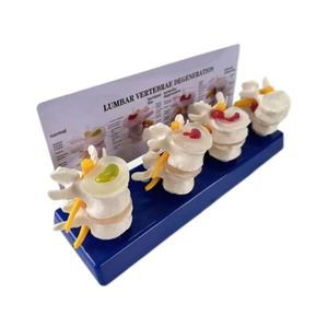 แบบจำลองการบีบอัดหมอนรองกระดูกที่แตกหักแบบสี่ขั้นตอน ตั้งแต่สุขภาพดีไปจนถึงภาวะหมอนรองกระดูกที่แตกหัก - Product Image 1