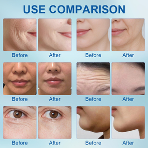 Máquina de Rejuvenecimiento Facial con Tecnología de Microcorriente para Tono Muscular y Reafirmación de la Piel en Toda la Cara, Dispositivo de Escritorio - Product Image 5