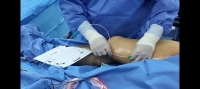 Nouvelle fibre optique conique imprimée NewPion Medical pour laser diffuseur SMA905 EVLA pour l'ablation veineuse