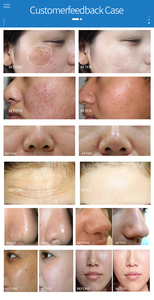 Microdermabrasion Diamond 6-in-1 Vacuum Hydrating Water Dermabrasion <b>Oxygen</b> Peel Skin Care Facial Deep Cleansing <b>Machine</b> Lips - Product Image 6