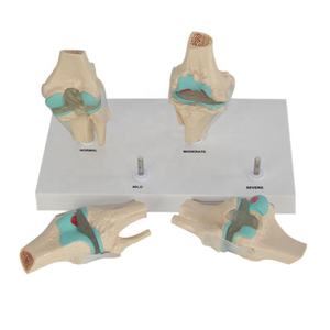 Anatomisch Pvc Kniegewricht Pathologisch Model 4 Stage Artrose Degeneratieve Menselijke Gewrichtsziekte Model - Product Image 6